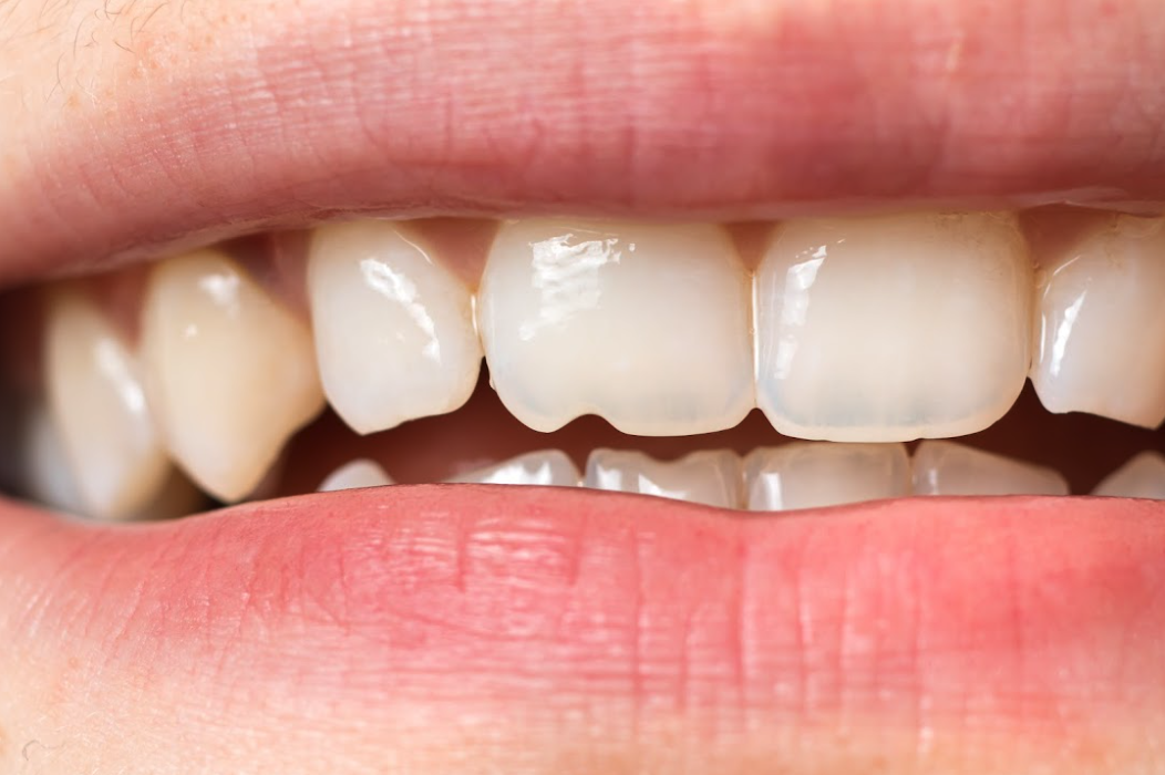 Chipped Teeth  Tooth Repair - Advanced Dentistry